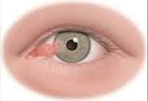 ما علاج ظفر العين ؟ 